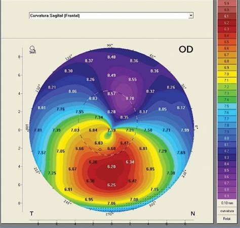 keratoconus thickness how to measure|keratoconus elevation map.